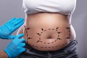 How To Get A Tummy Tuck Paid For By Insurance